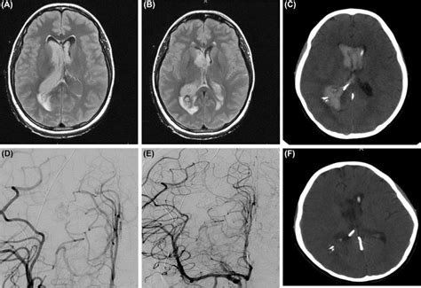 clinical aspects  intraventricular hemorrhage clinical tree