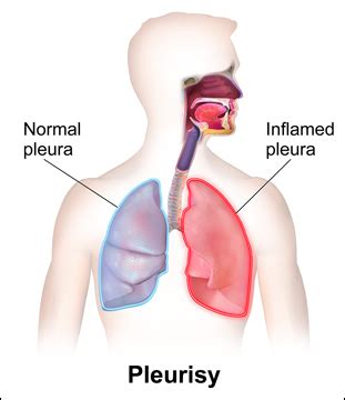 Herbal Remedies for Pleurisy, Ayurvedic Treatment - Causes & Symptoms