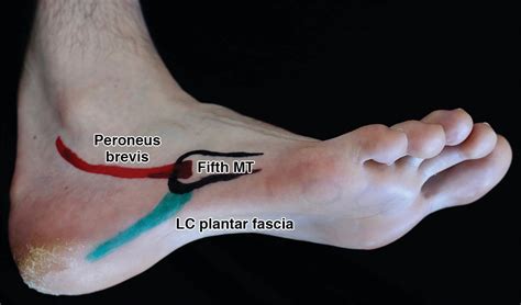 Not One Of The Usual Suspects Mri Features Of Insertional Lateral Cord