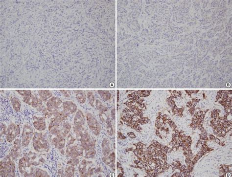 Representative description of HER2 expression in breast cancer ...