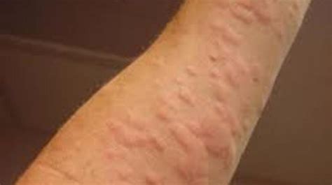 How Allergic Itchy Hives and Sneezing Transform Into Assertive Health