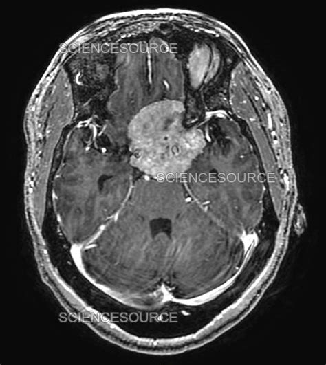 Planum Sphenoidale Meningioma MRI Stock Image Science Source Images