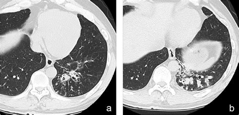 Axial Reformatted Ct Images Lung Window Setting Show Bronchiectasis