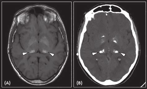 Fabry Disease Mri A And Ct B Reveal T Hyperintensities A And