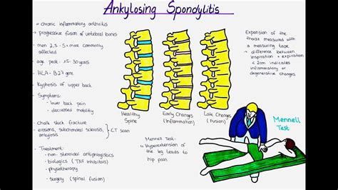 Ankylosing Spondylitis Morbus Bechterew Etiology Symptoms