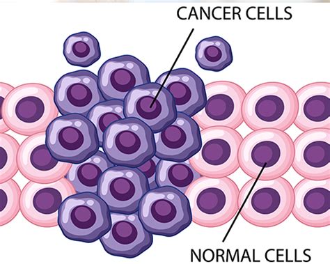 Malignant Tumors | Symptoms Types Treatments | Optimists Healthcare