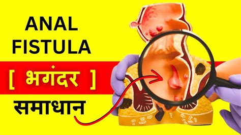 Anal Fistula Kya Hota Hai Fistula Diagnosis Surgery And Non Surgery