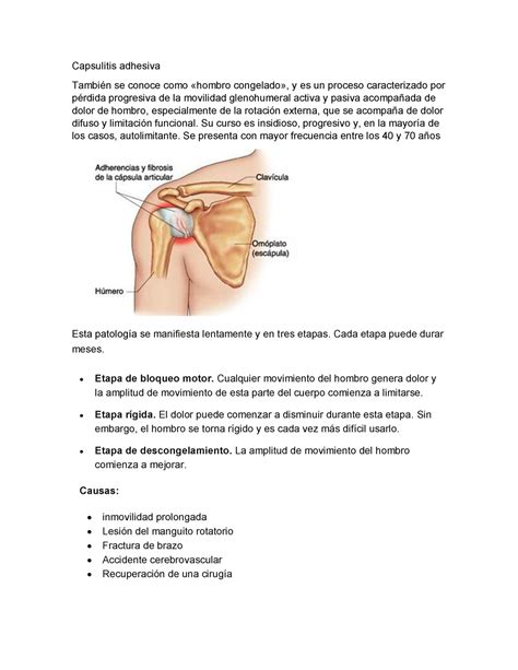 Resumen De Capsulitis Adhesiva Capsulitis Adhesiva Tambi N Se Conoce