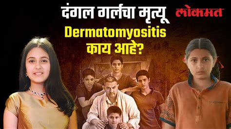 दंगल गर्ल सुहानी भटनागरचा Dermatomyositis ने मृत्यू काय आहे हा आजार