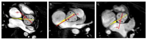 Aortic Root Rotational Angle Measurement The Rotational Angle Is The