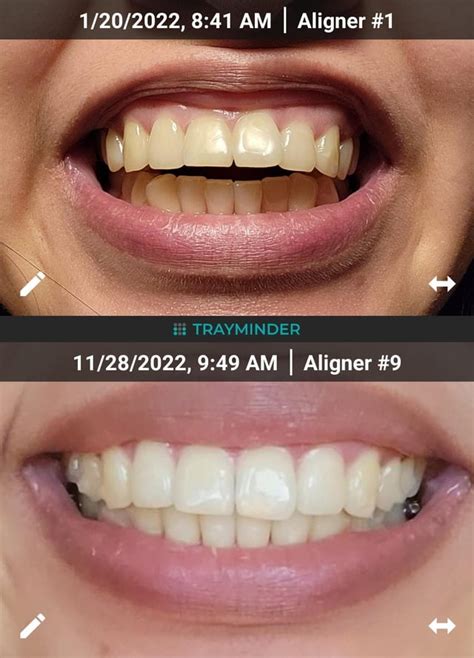 Dark spot on front tooth (near gum line) : r/Invisalign