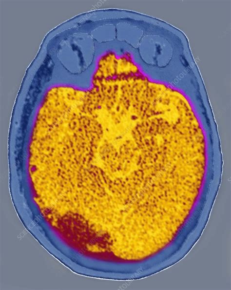 Brain Stroke, MRI - Stock Image - C027/0962 - Science Photo Library