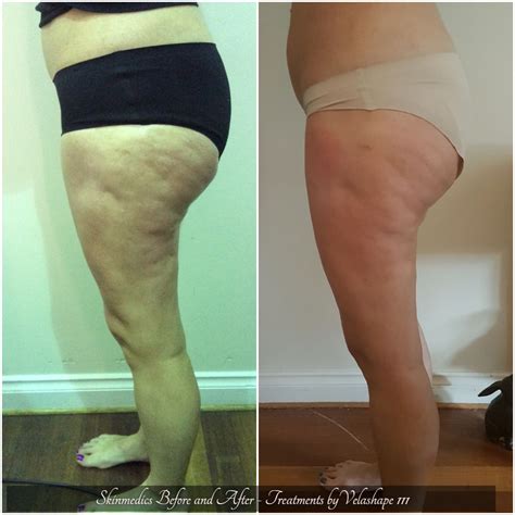 Contouring Cellulite Velashape Iii