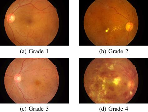 Figure 3 From Automated Grading Of Diabetic Retinopathy In Retinal