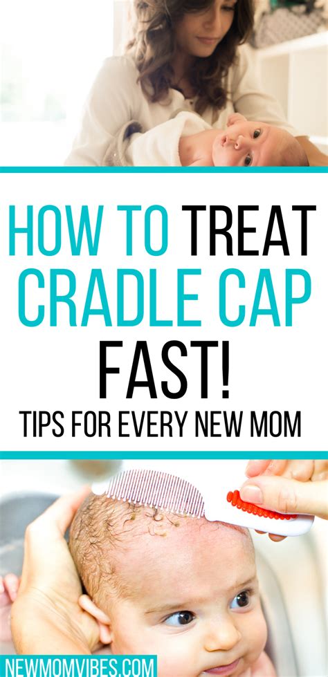 Cradle Cap Remedies Artofit