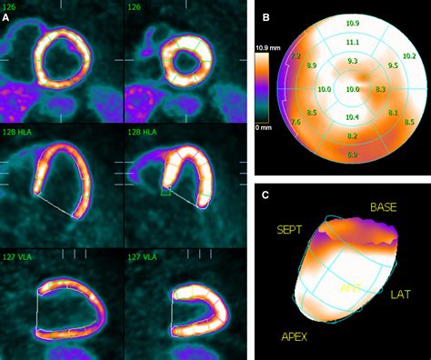 Left Ventricular Function And Volumes From Gated N Ammonia Positron