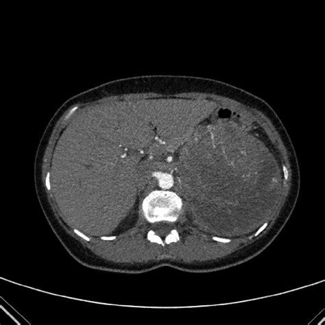 Arterial Phase Axial Ct Image Shows A Small Feeding Vessel Arising