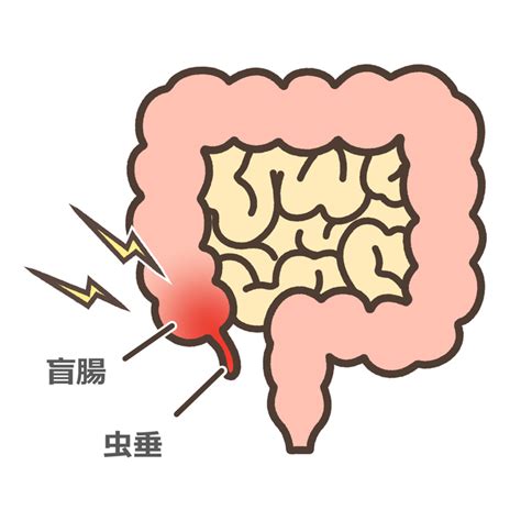 「虫垂炎」とは？原因・症状・治療法についても解説！【医師監修】 メディカルドック