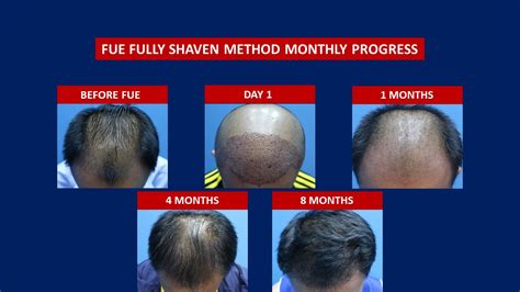 Fue Hair Transplant Before After Hair Transplant Centre Malaysia