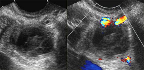 Hemorrhagic Cyst Ultrasound