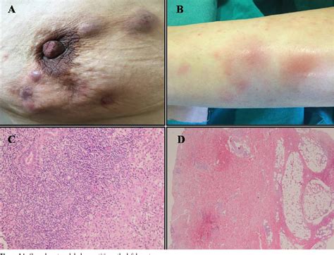 PDF Coexistence Of Idiopathic Granulomatous Mastitis And