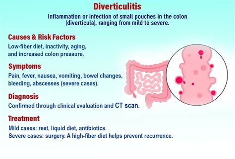 Diverticulitis Symptoms, Causes, and Treatment - Dr Patta