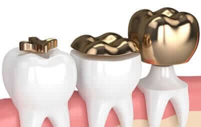 Dental Onlays McKinney TX | Inlays and Onlays Procedure near me