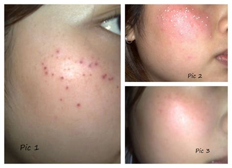 Fay Jesselton: Moles Removal