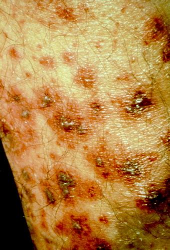 Cutaneous Manifestations Of Internal Malignancy Thiers 2009 Ca A Cancer Journal For