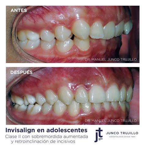 Invisalign Para Adolescentes Clase Ii Con Sobremordida Aumentada Y