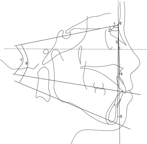 Skeletal Measurements Of The Lateral Cephalometric Analysis Sna