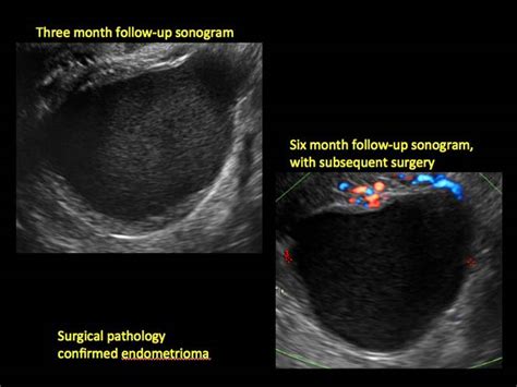 Imaging The Endometrioma And Mature Cystic Teratoma Mdedge Obgyn