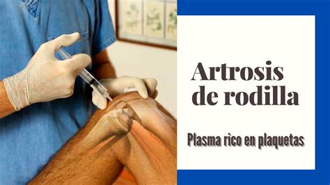 Artrosis De Rodilla Plasma Rico En Plaquetas Youtube