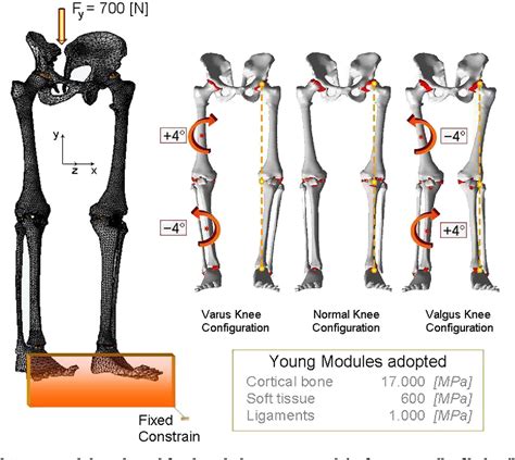 Figure 1 From Stress Shielding In The Bony Chain Of Leg In Presence Of Varus Or Valgus Knee