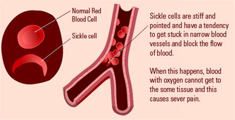 SICKLE CELL RETINOPATHY – Cypress Eye Centre