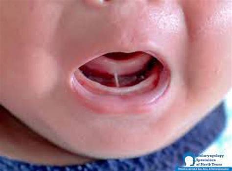 Ankyloglossia Medizzy