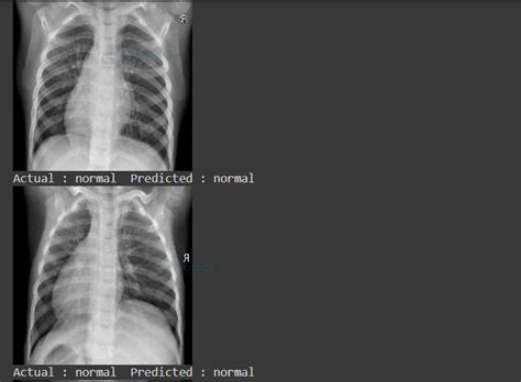 Pneumonia Detection Using Deep Learning Project Gurukul