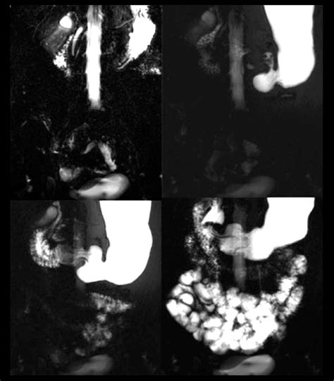 Mr Fluoroscopy Shows Normal Progressive Filling Of The Stomach