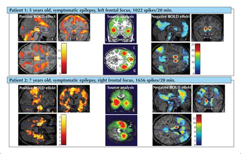 Jle Epileptic Disorders Pathophysiology Of Encephalopathy Related