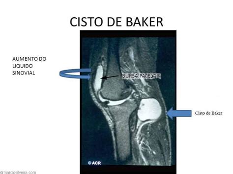 Cisto Popl Teo Ou De Baker Causas E Sintomas Dr M Rcio Silveira