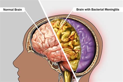 Méningite Causes Symptômes Et Traitement Fmedic