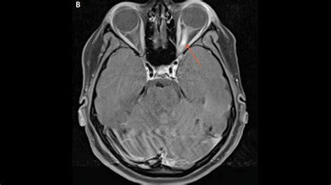 Nmosd Lesions The Neurology Hub