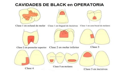 Caries Dentales Que S N Y Como Se Clasifican