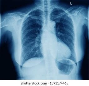 Anteroposterior Chest Radiograph Woman Showing Normal Stock Photo