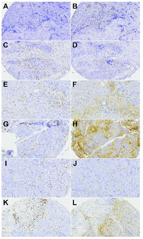 Immunohistochemical Staining Of Cd8 Tils And Pd L1 Expressing Tumor