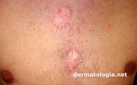 Dermatite Seborreica Caspa Seborr Ia Imagens Dermatologia