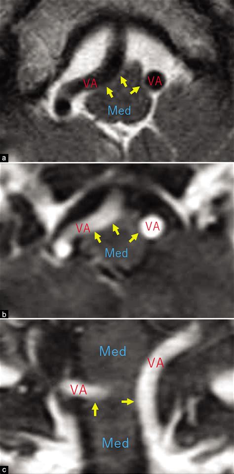 Surgical Neurology International