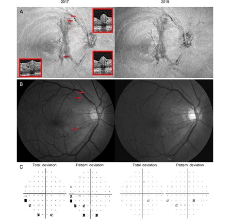 Comparisons between 2017 and 2019 A The en face 52 μm slab image of