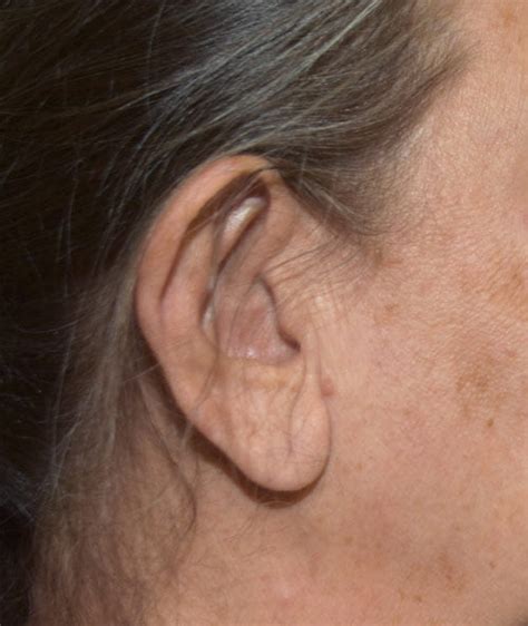 Otoplasty With Earlobe Reduction Mandell Brown Plastic Surgery Center