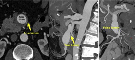 Post Dissection Aneurysm Of The Superior Mesenteric Artery With